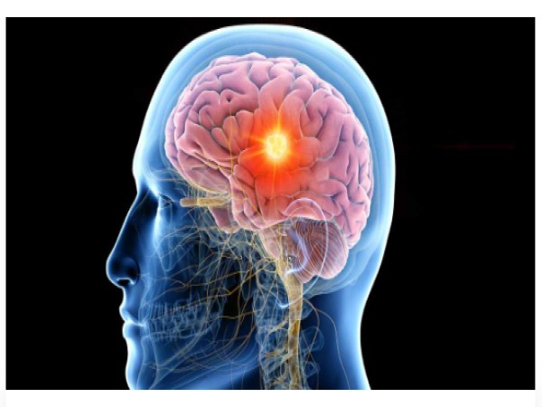 Epilepsy in Adults